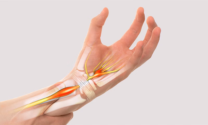 What is carpal tunnel syndrome? What is carpal tunnel syndrome?