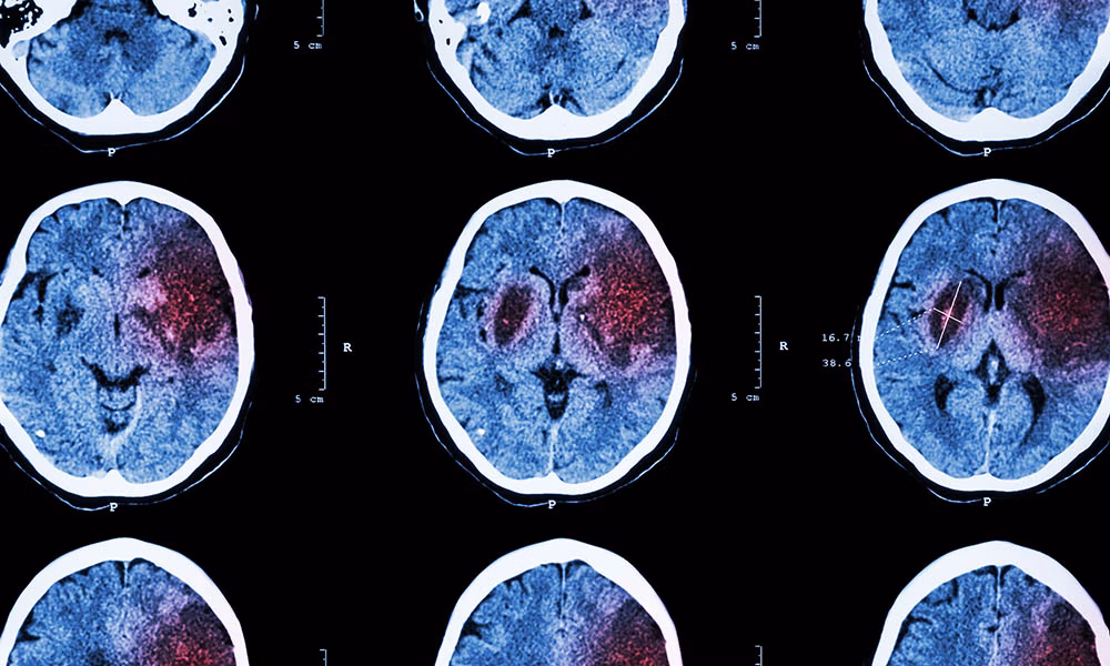 Consequences of a stroke Consequences of a stroke