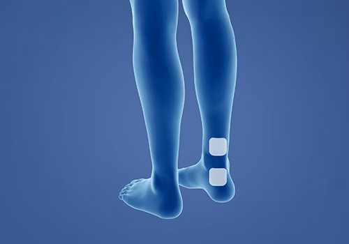STIWELL Therapie | Überaktive Blase STIWELL Therapie | Überaktive Blase