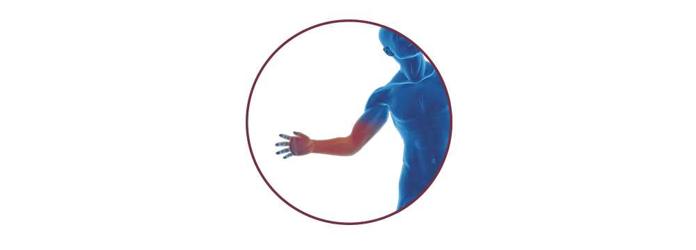 STIWELL® | Functional electrical stimulation (FES) for a hand injury STIWELL® | Functional electrical stimulation (FES) for a hand injury
