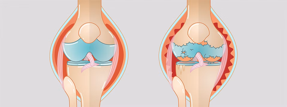 What is gonarthrosis (knee arthrosis)? What is gonarthrosis (knee arthrosis)?