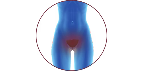 FES bei Inkontinenz | STIWELL® Neurorehabilitation