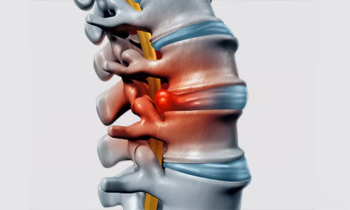 What is a herniated disc? What is a herniated disc?