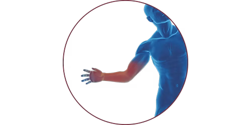 FES bei Handverletzung | STIWELL® Neurorehabilitation