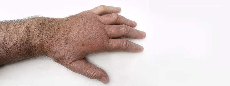 Was ist das komplexe regionale Schmerzsyndrom (CRPS)? Was ist das komplexe regionale Schmerzsyndrom (CRPS)?