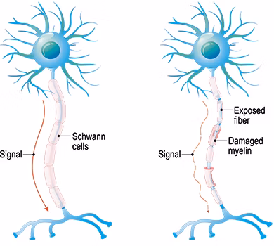 Causes of multiple sclerosis Causes of multiple sclerosis
