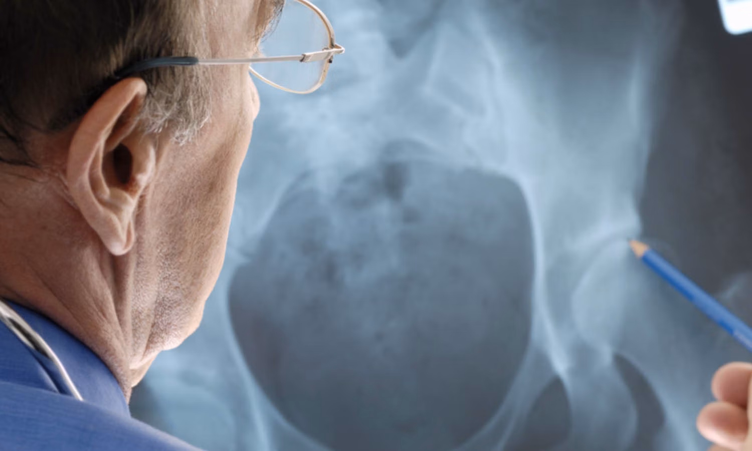 Diagnosis: hip arthrosis Diagnosis: hip arthrosis