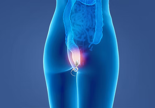 STIWELL® Therapie | Stuhlinkontinenz STIWELL® Therapie | Stuhlinkontinenz