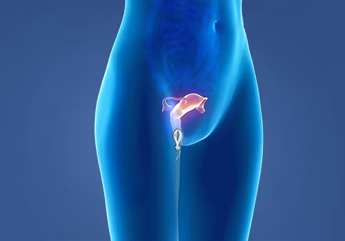 STIWELL® Therapie | Drang-/Belastungsinkontinenz STIWELL® Therapie | Drang-/Belastungsinkontinenz